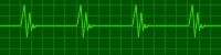 heartbit